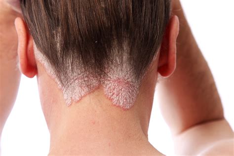 Scalp Psoriasis: Symptoms, Causes, Treatment & Tips - BeatPsoriasis.org