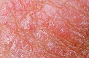 Common causes of red, dry, burning itchy scrotum