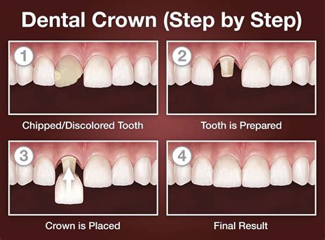 Tooth Crown Cost
