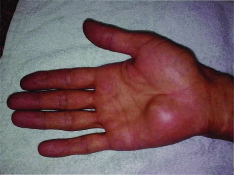 hand   patient   lesion   hypothenar region