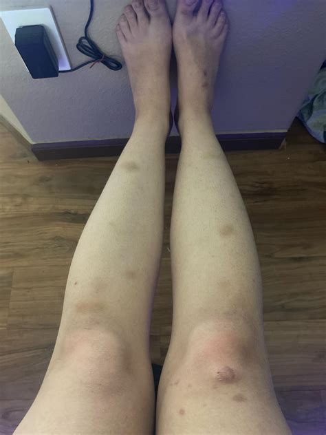 Why do i get random bruising all over my legs? : r/medical_advice