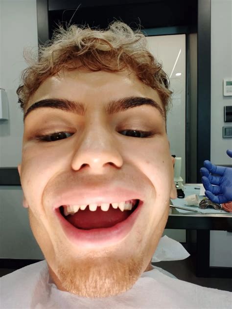 Man’s warning after Turkey teeth surgery leaves him looking ‘like a shark’