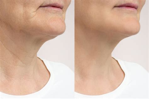 Volnewmer Antes E Depois