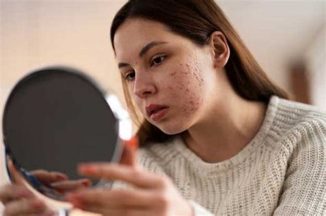 От чего вылазиют прыщи на лице