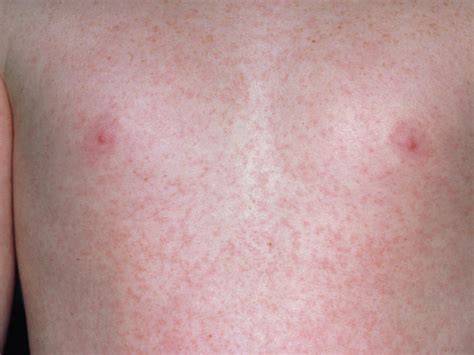 Mild Measles Pictures