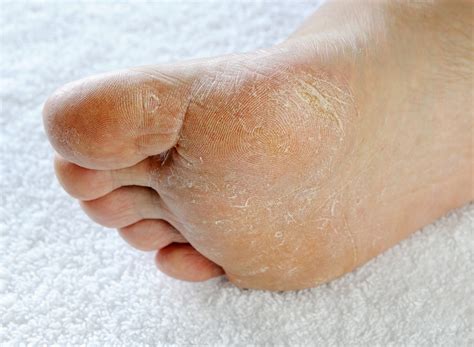 how to know if athlete's foot is getting better