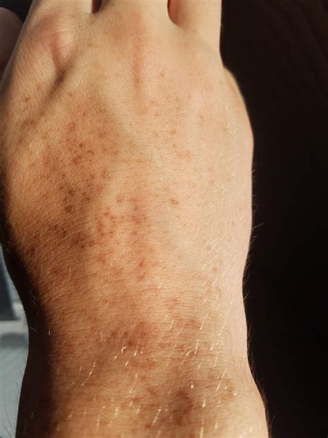 Strange Dark Spot On Skin at Gordon Nelson blog