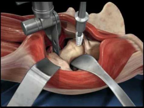 Direct Anterior Approach Hip Replacement - YouTube