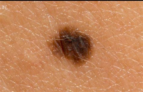 kenali penyakit melanoma yesdokcom