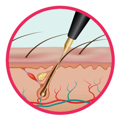 The History of Electrolysis - ZAP! Electrolysis