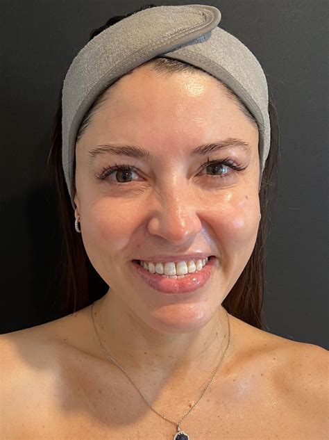 What Is the HydraFacial Therapy and Why Is It So Standard? - Doctor Woao