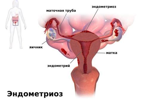 Визанна при эндометриозе: отзывы и инструкция по применению