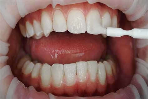 ¿Qué es el Flúor dental? - Clinica Dental Sonrisa Segura