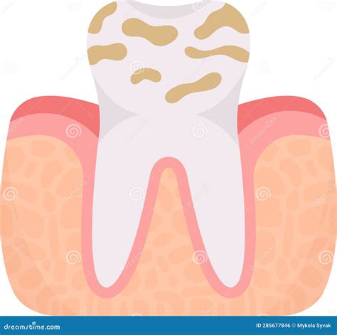 Dental Plaque Tooth Problem Stock Vector - Illustration of plaque