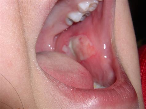 Why do I keep biting my cheek? | News | Dentagama