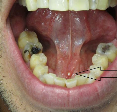 Submandibular Salivary Gland _ Sialadenitis (Salivary Gland Infection