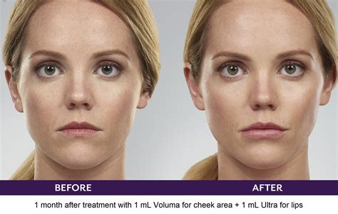 Juvederm Cheeks