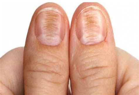 Ongle strié : que faire pour l'éviter