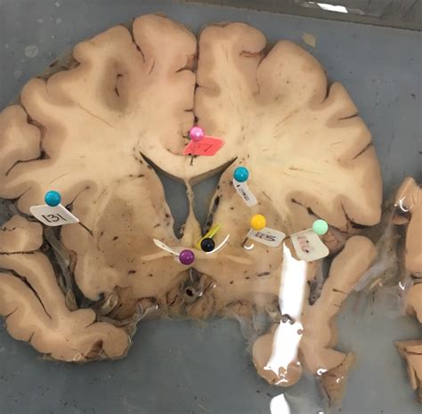 brain coronal cut  diagram quizlet