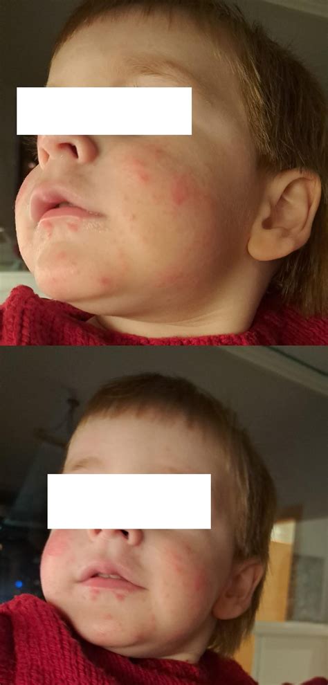 Any opinions on my toddler's red skin? Happening since 2 months, some