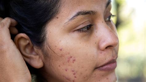 Very Mild Acne Scars