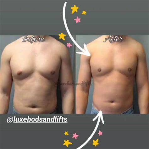 💕💕#Ultrasonic Cavitation is also known as Fat Cavitation or Lipo ...