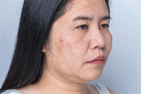 Pimple Face Stock Photos, Images and Backgrounds for Free Download