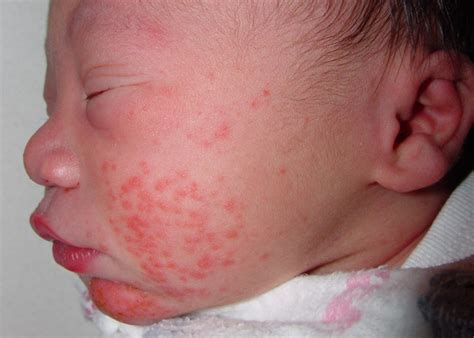 Neonatal Acne (Acne - neonatal and infantile) - Dermatology Advisor