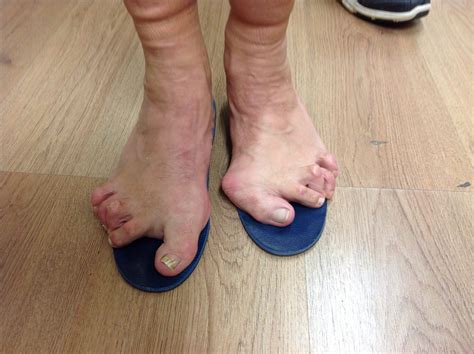 Compleet Feet and National Bunion Day 25th April 2019 - Compleet Feet