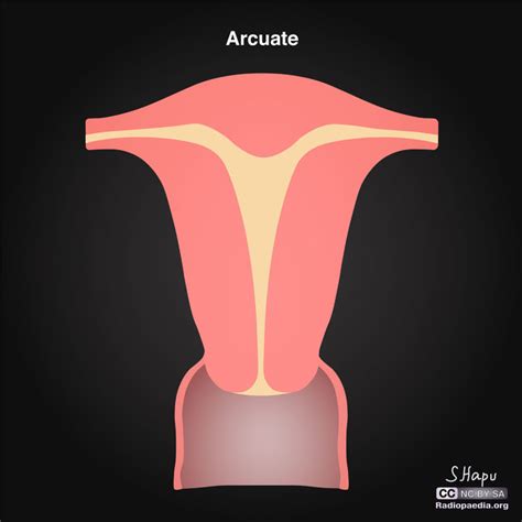Arcuate Uterus Ultrasound