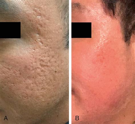 The Rullan Two-Day Croton Oil–Phenol Chemabrasion Peel - Clinical Tree
