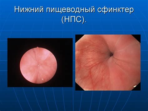 Эндоскопическая анатомия пищевода, хиатальные грыжи - презентация онлайн