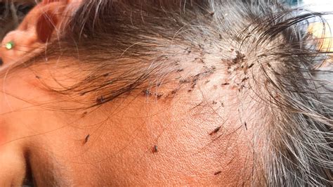 Does Vinegar Remove Nits From Hair at Wanda McQueen blog