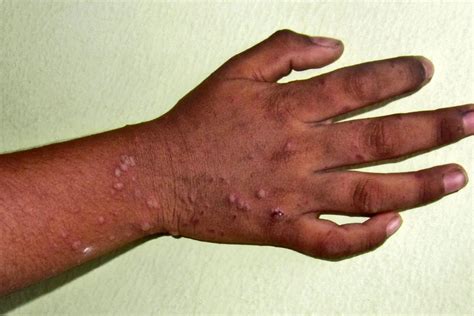 SYMPTOMS AND TREATMENT OF HAND, FOOT, AND MOUTH DISEASE - Chiid Health