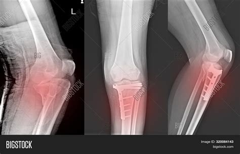 X-ray Knee Joint Image & Photo (Free Trial) | Bigstock