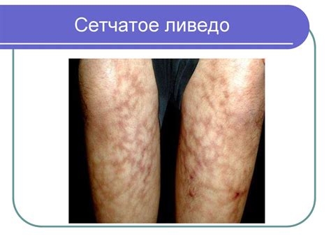 Системная красная волчанка - презентация онлайн