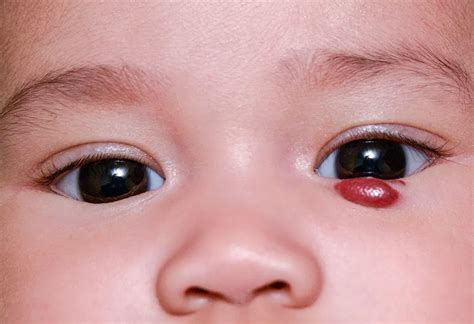 Infantile Hemangioma: Causes, Symptoms and Treatment