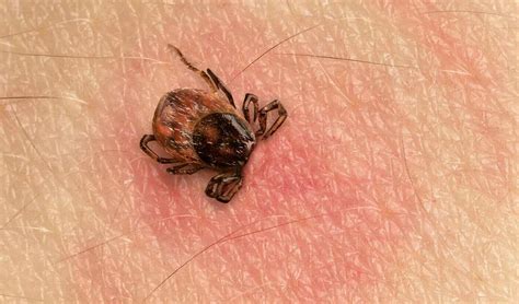 Morsure de tique : il faut bien surveiller la rougeur | PassionSanté.be