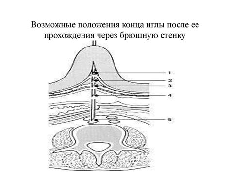 Прикладная анатомия брюшной стенки. Техника лапароскопии - online ...