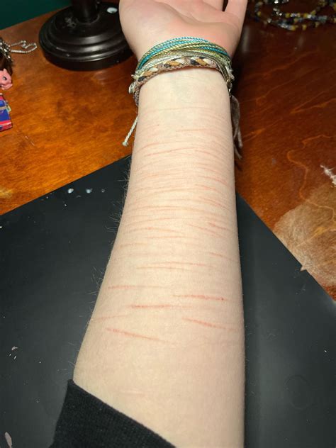 My sh scars so far : r/SelfHarmScars