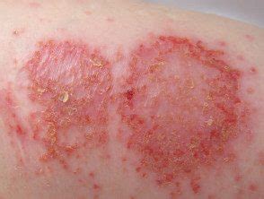 Discoid eczema - Hoogstra - Medical Centers