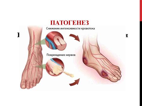 Синдром диабетической стопы - презентация онлайн