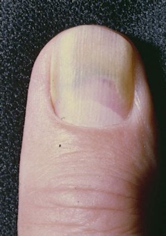 Green Nail Syndrome (GNS, Pseudomonas nail infection, chloronychia, green striped nails ...