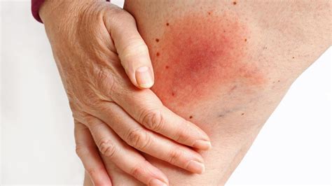 Cos'è la Malattia di Lyme - Cerba HealthCare Italia