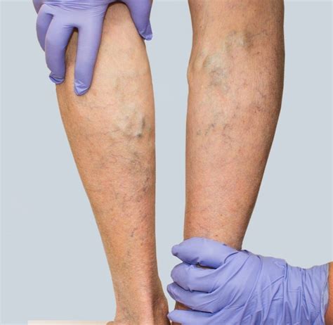 melbourne vein group