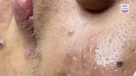 Exploding Blackheads Videos at Frieda Leach blog