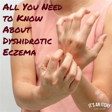 What is Dyshidrotic Eczema? | It's an Itchy Little World