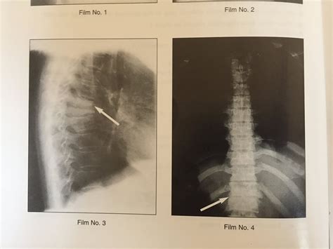 XRAYS OF TUBERCULOSIS OF SPINE