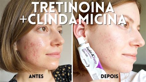 Antes E Depois Vitacid