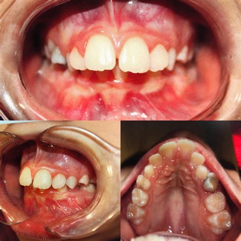 Buck Teeth: What They Are _ What Causes Buck Teeth – TSQK